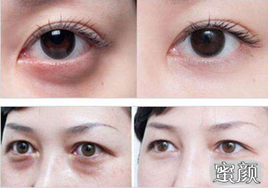 科技揭秘，最新去眼袋最佳方法，重塑眼部美麗新篇章！