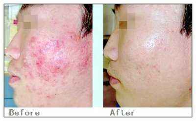 激光祛疤價(jià)格詳解，深度解析與觀點(diǎn)闡述