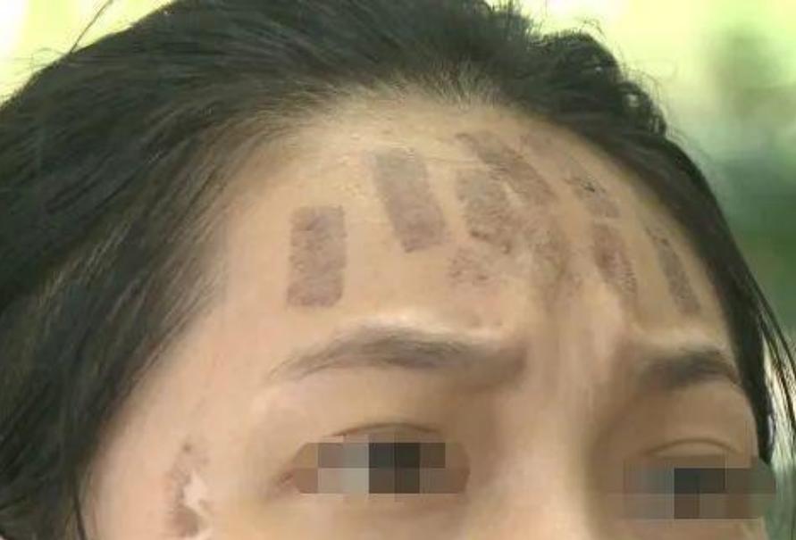 成都光子嫩膚價(jià)格，科技重塑肌膚之美