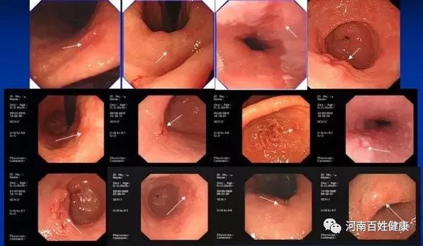 最新胃腸鏡技術(shù)，醫(yī)學(xué)領(lǐng)域的革新之星