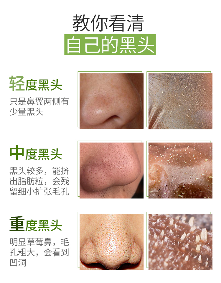 最新去黑頭教程視頻匯總，科技助力美麗重塑，黑頭無憂新篇章