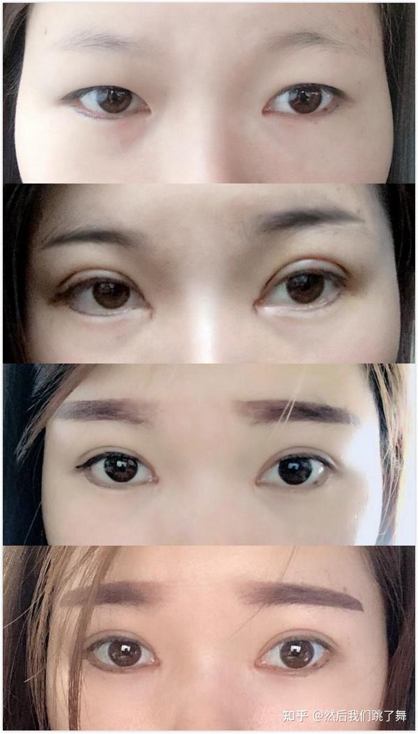 雙眼皮新技術(shù)揭秘，小明的魔法雙眼皮之旅